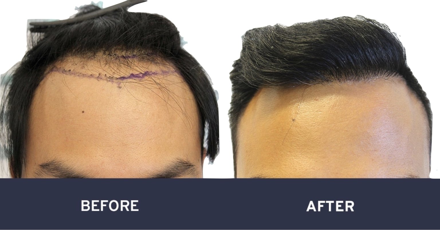 Cendant hair transplant before and after photos - Cendant Stem Cell Center