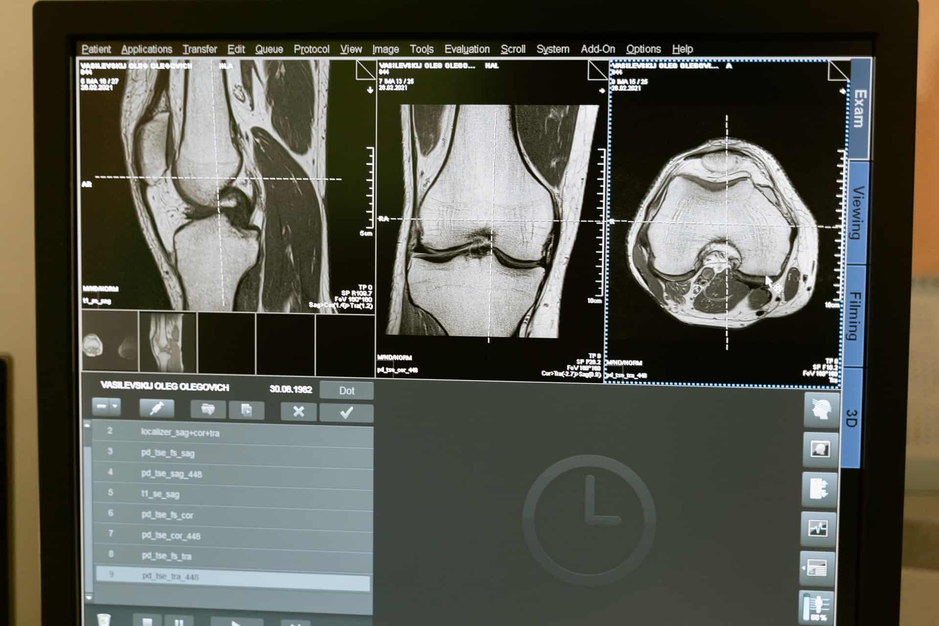 High-resolution MRI scans of knee and shoulder joints for stem cell therapy consultation at Cendant Stem Cell Center.