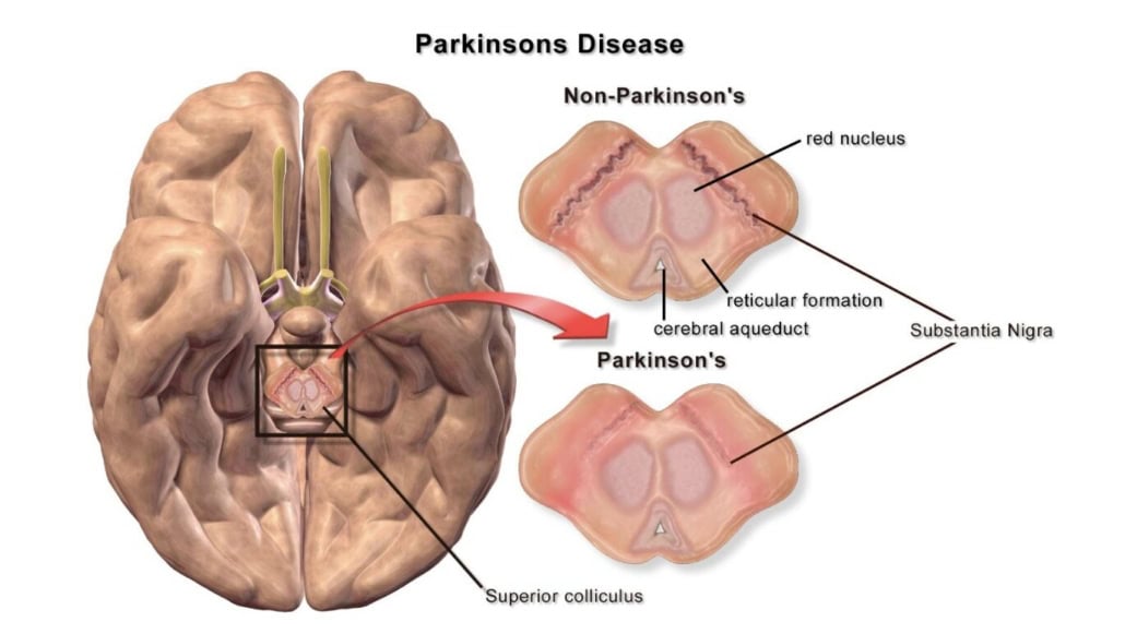 Brain diagram showing Parkinson's and non-Parkinson's areas with labels.