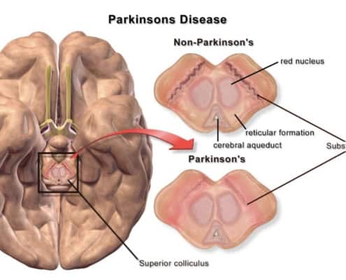 Brain diagram showing Parkinson's and non-Parkinson's areas with labels.