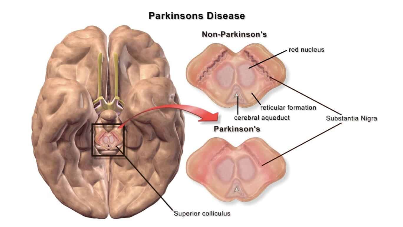 Brain diagram showing Parkinson's and non-Parkinson's areas with labels.