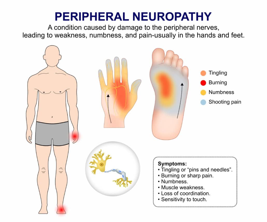 Peripheral,Neuropathy,Infographic,Flashcard,Illustration Diagram of peripheral neuropathy symptoms and affected areas.