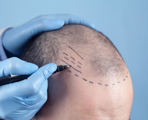 How long does a hair transplant last in Denver, CO