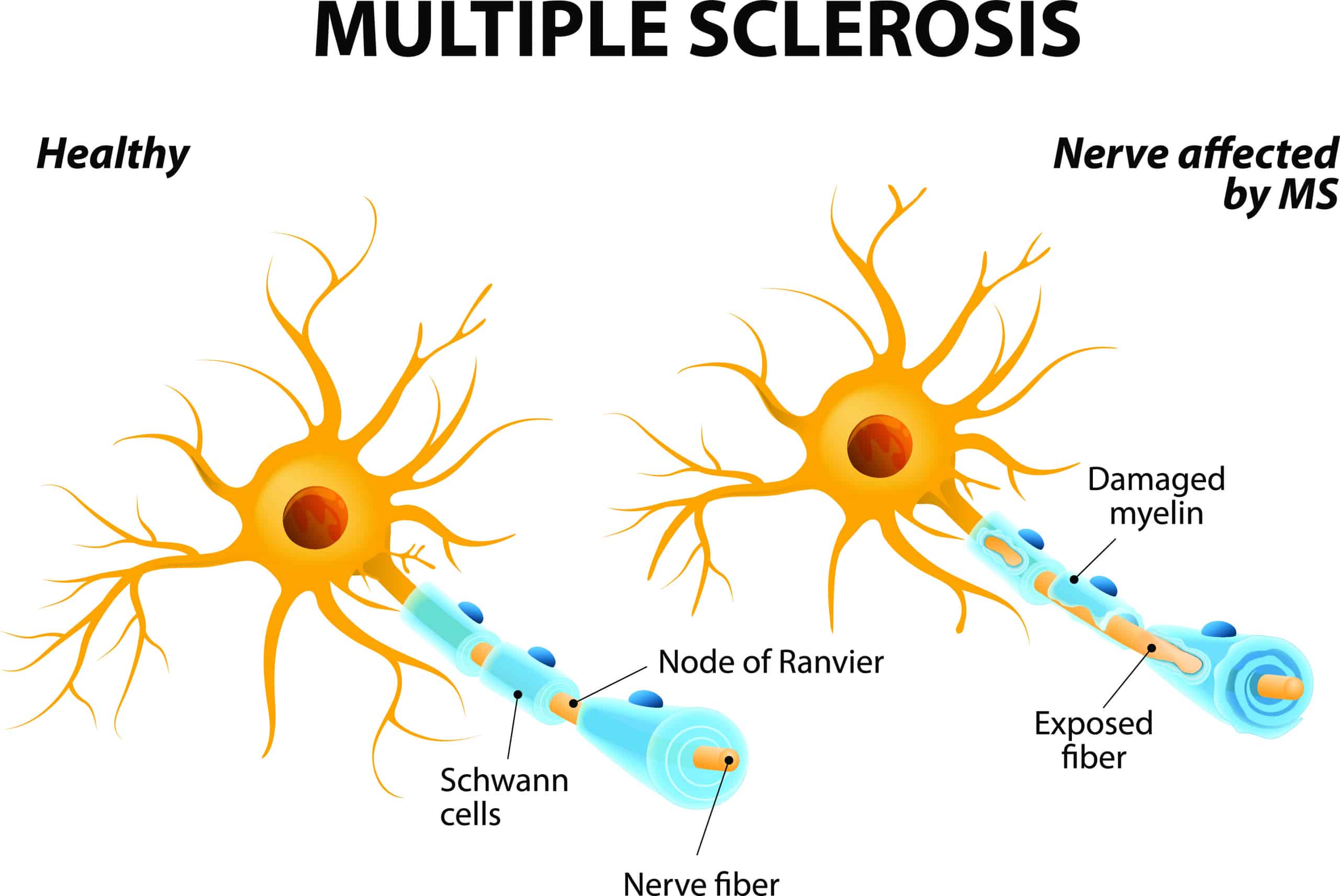 Regenerative stem cell therapy for multiple sclerosis at Cendant Stem Cell Center.